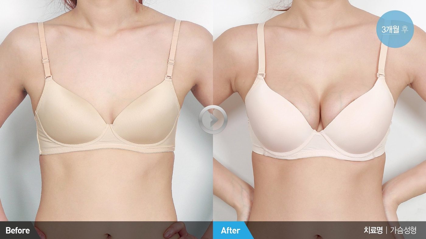 Breast reduction surgery natural postoperative result at Newline Clinic in Busan, Korea