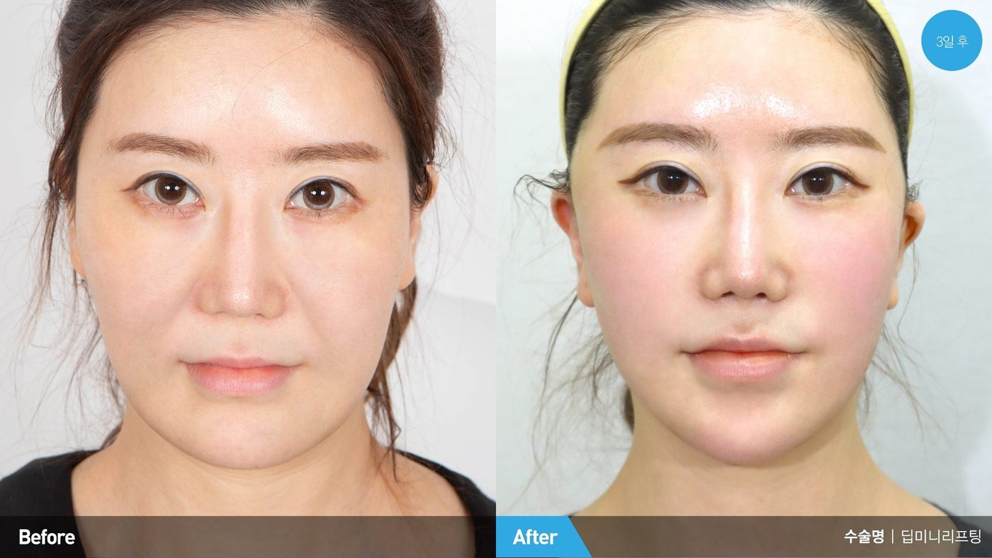 Deep Mini Lift natural post-treatment portrait at Newline Clinic in Busan, Korea
