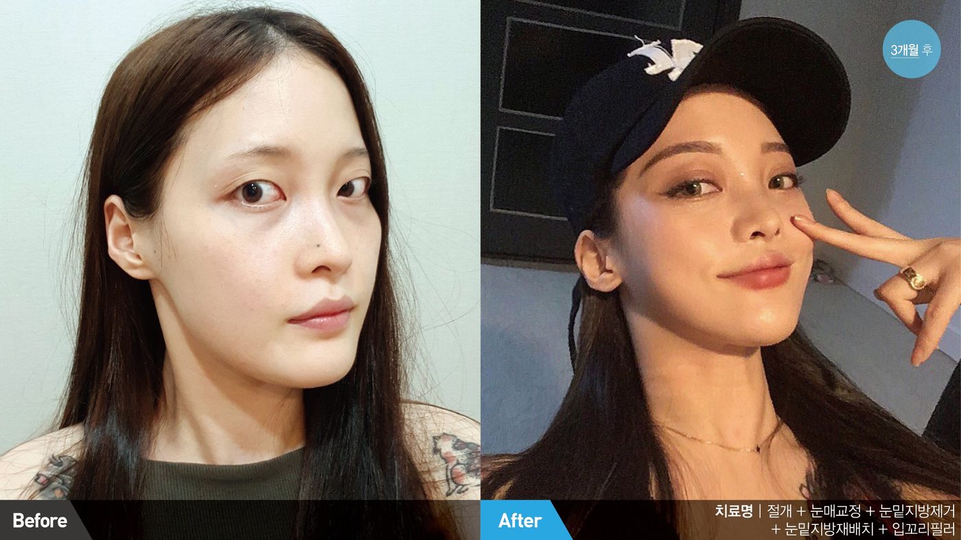 Lateral canthoplasty naturally elongated eye shape at Newline Clinic in Busan, Korea