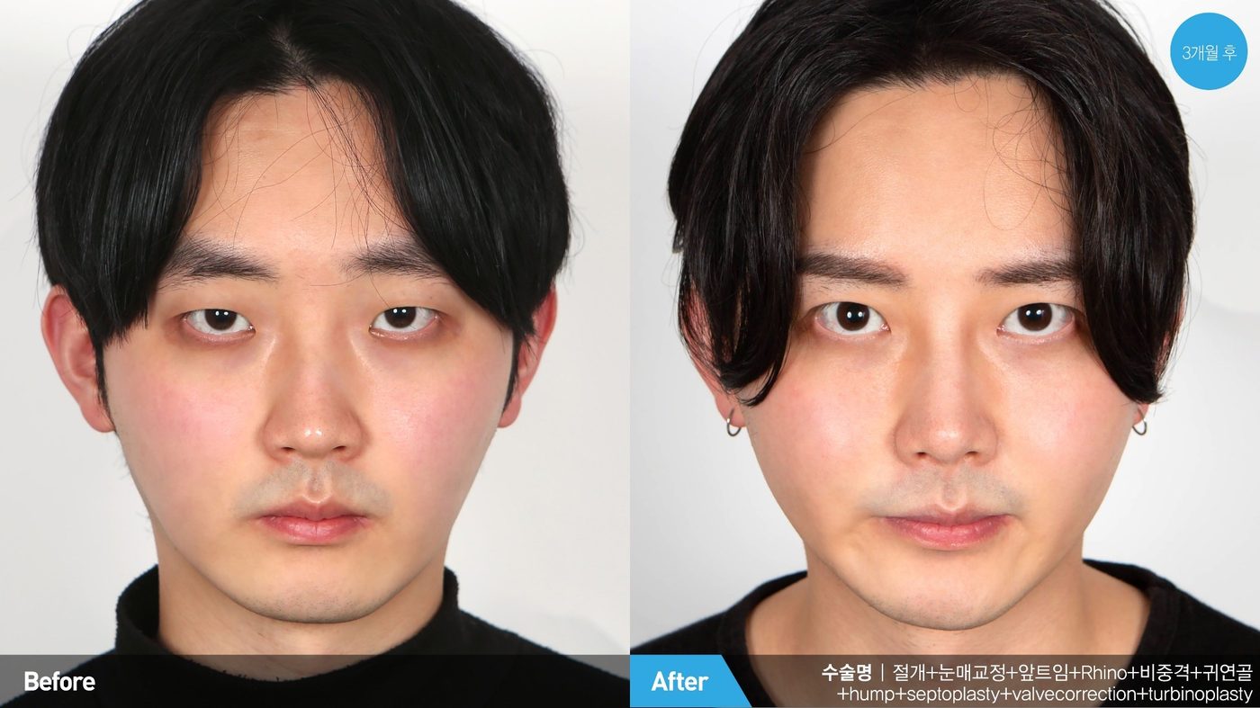Natural-looking male eyelid surgery result at Newline Clinic in Busan, Korea