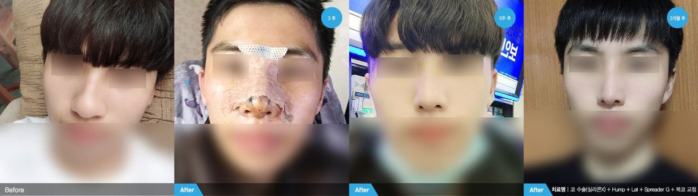 Male plastic surgery natural result at Newline Clinic in Busan, Korea