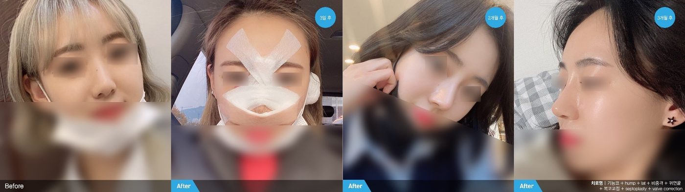 Nasal reconstruction restored contour result at Newline Clinic in Busan, Korea