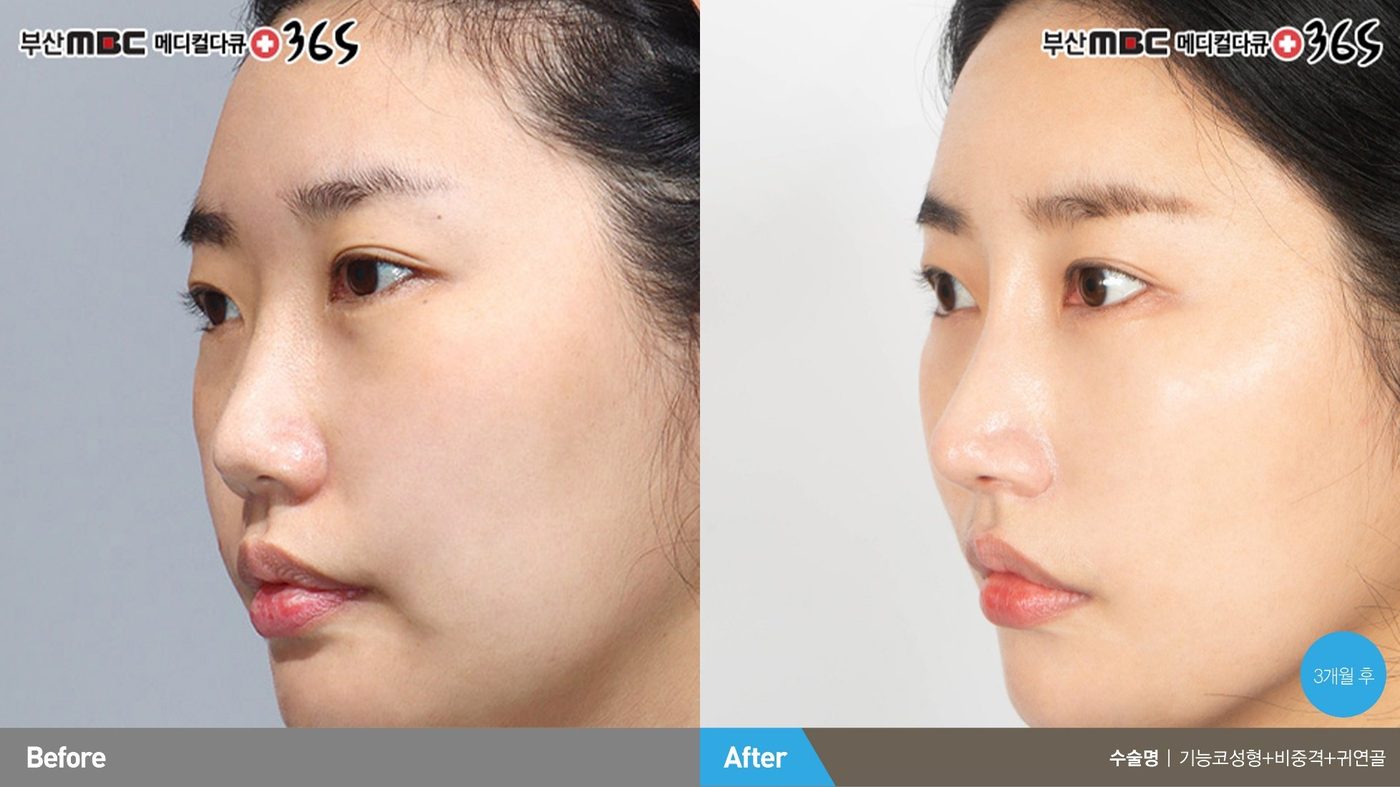 Natural nasal contour after nasal valve reconstruction at Newline Clinic in Busan, Korea