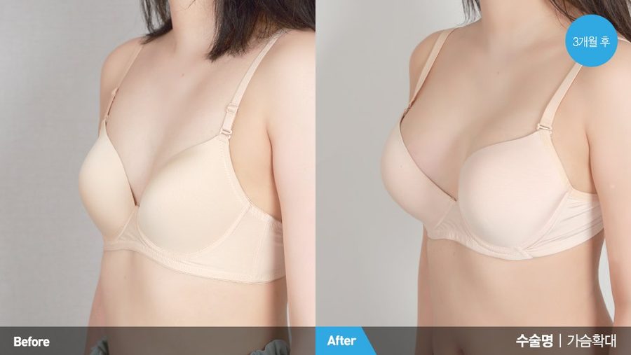 Accessory breast removal result with arm raised — Newline Clinic Busan