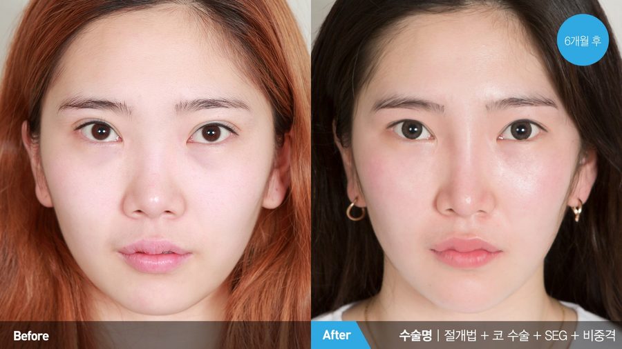 Nostril flare when smiling after alar reduction — Newline Clinic Busan