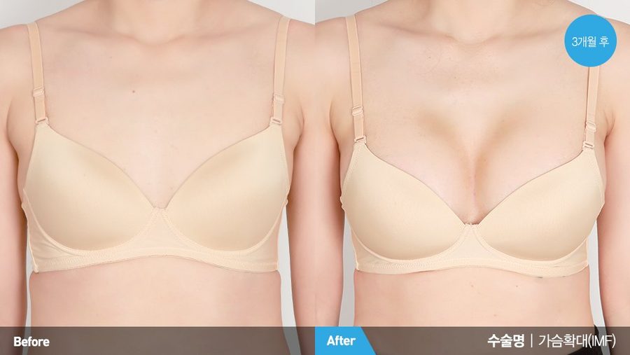Breast reduction before and after front view — Newline Clinic Busan