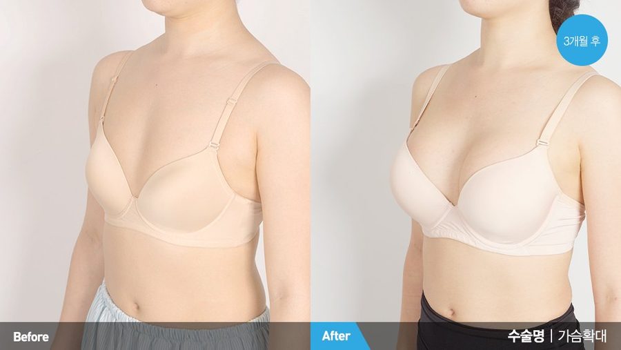 Implant malposition correction result — Newline Clinic Busan