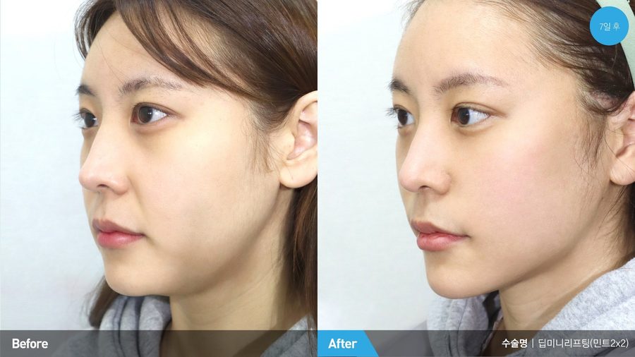 Heavy brow corrected after brow lift — Newline Clinic Busan