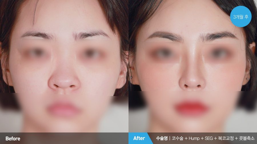 Tip refinement during crooked nose correction — Newline Clinic Busan