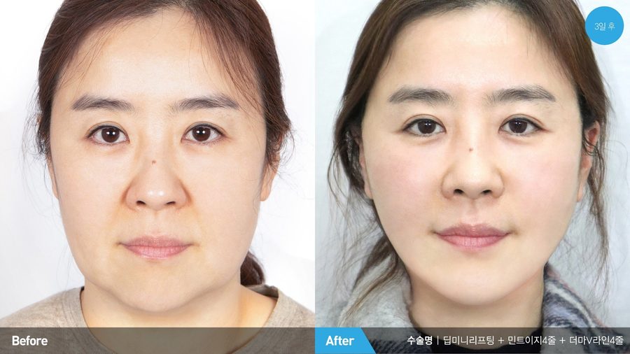 Early jowl improvement after Deep Mini Lift — Newline Clinic Busan