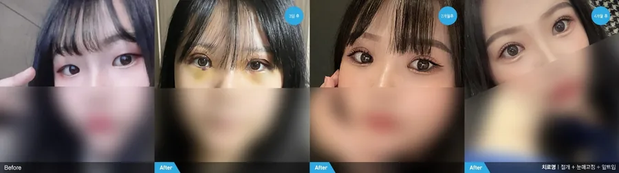 Double eyelid surgery before and after front view — Newline Clinic Busan