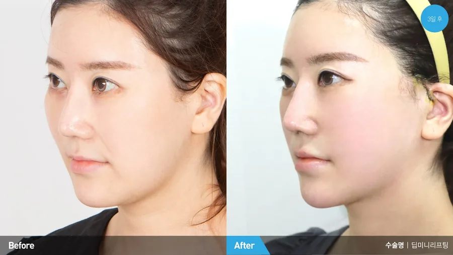 Facial lifting before and after front view — Newline Clinic Busan