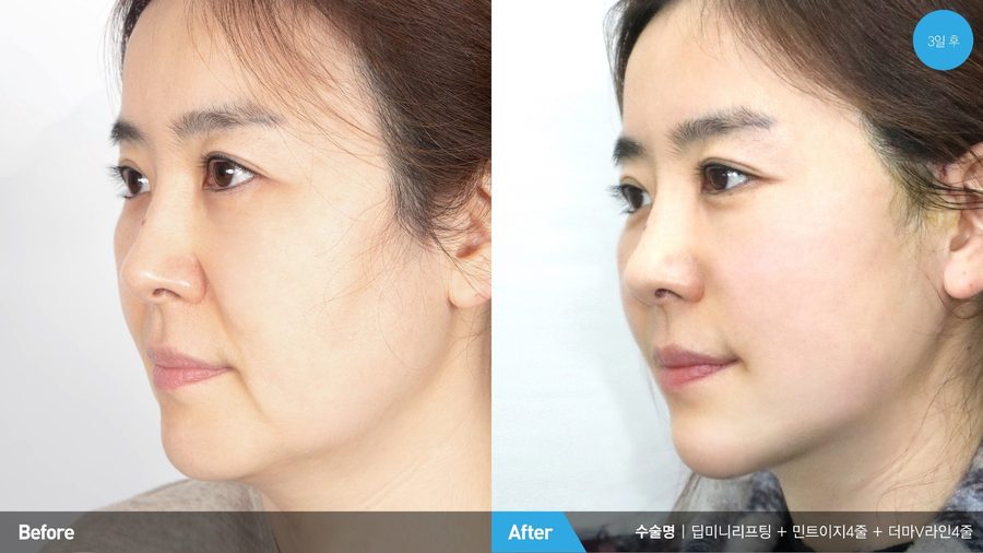Combined facial rejuvenation procedures result — Newline Clinic Busan