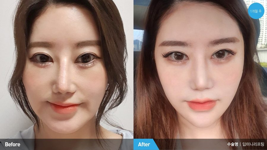 Facial harmony after personalized lifting — Newline Clinic Busan