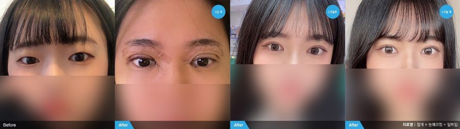Smoother lid-cheek transition after fat repositioning — Newline Clinic Busan