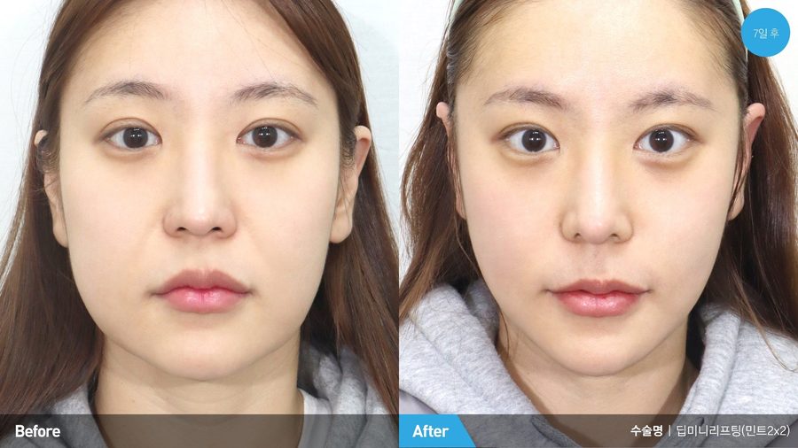 Lowered natural hairline after forehead reduction — Newline Clinic Busan
