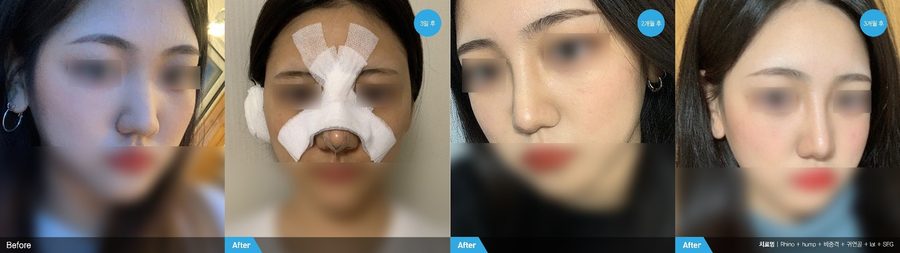 Hump nose rhinoplasty before and after side profile — Newline Clinic Busan
