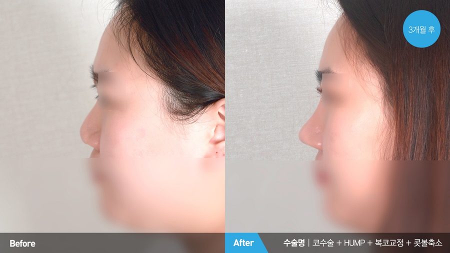 Nasal tip refinement with ear cartilage — Newline Clinic Busan