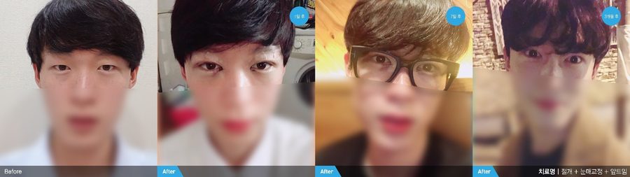 Thin subtle male eyelid crease result — Newline Clinic Busan