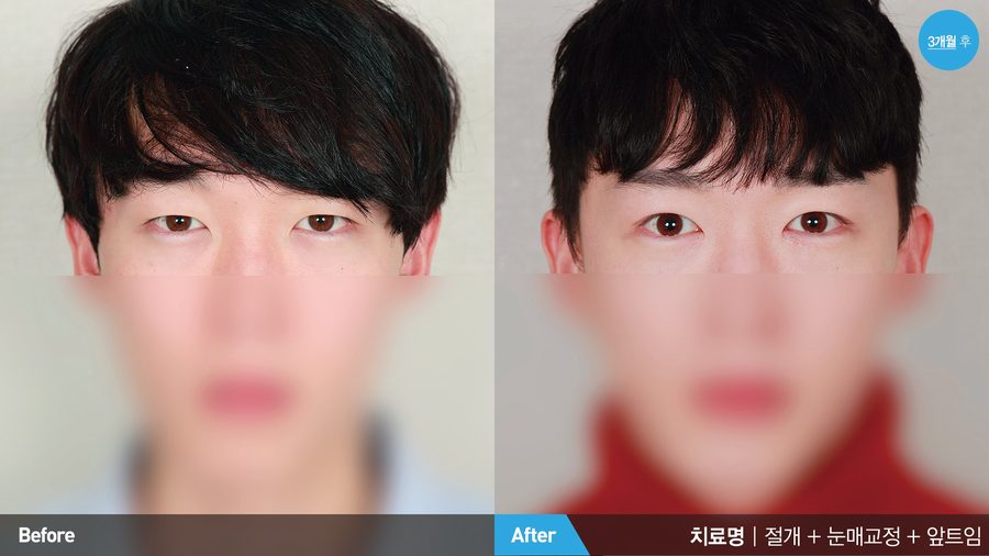 Harmonious male facial balance after eye surgery — Newline Clinic Busan