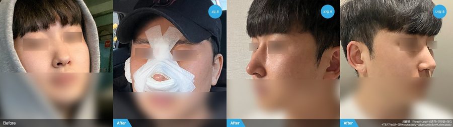Male rhinoplasty before and after side profile — Newline Clinic Busan
