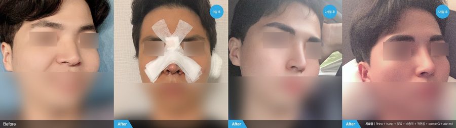 Straighter dorsal line after male rhinoplasty — Newline Clinic Busan