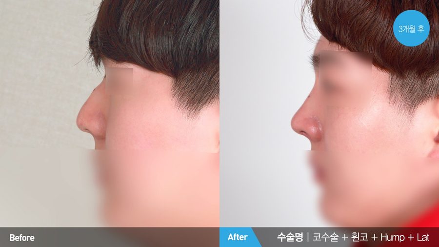 Male rhinoplasty bridge result — Newline Clinic Busan