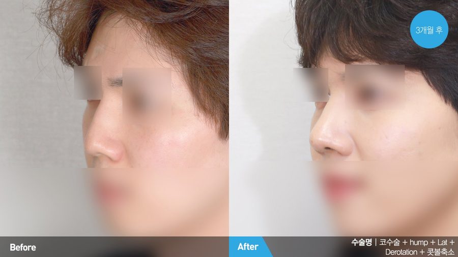Athletic body contouring result for male patient — Newline Clinic Busan