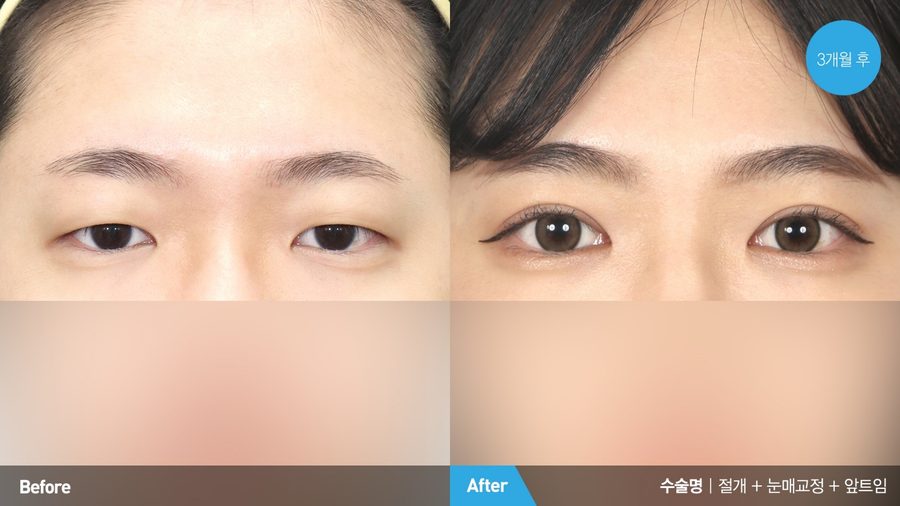 Facial harmony after medial canthoplasty revision — Newline Clinic Busan
