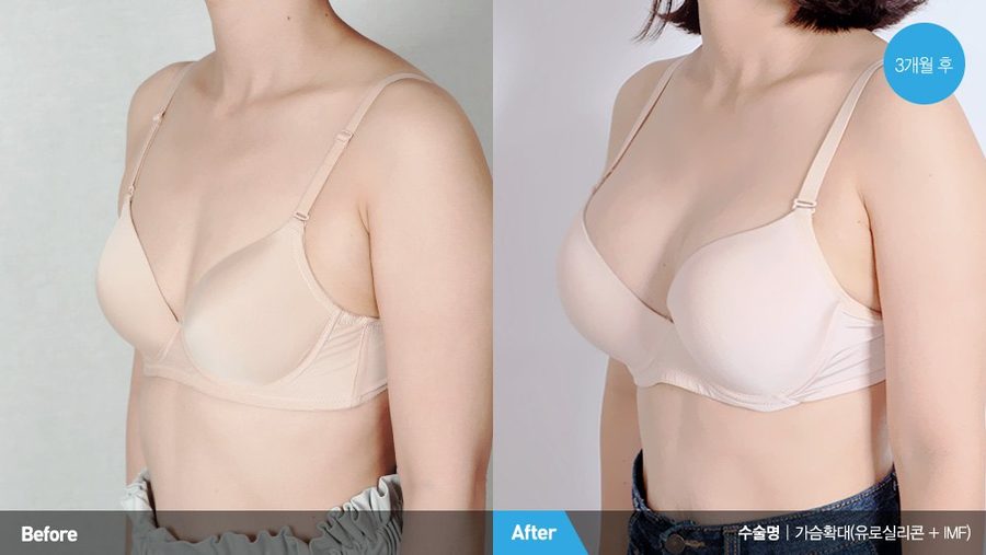 Mentor MemoryGel Xtra three-quarter view result — Newline Clinic Busan