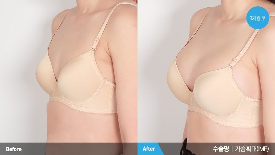 Vectra XT 3D simulation compared with postoperative result — Newline Clinic Busan
