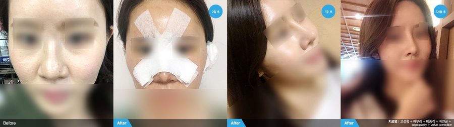 Structural collapse corrected by nasal reconstruction — Newline Clinic Busan