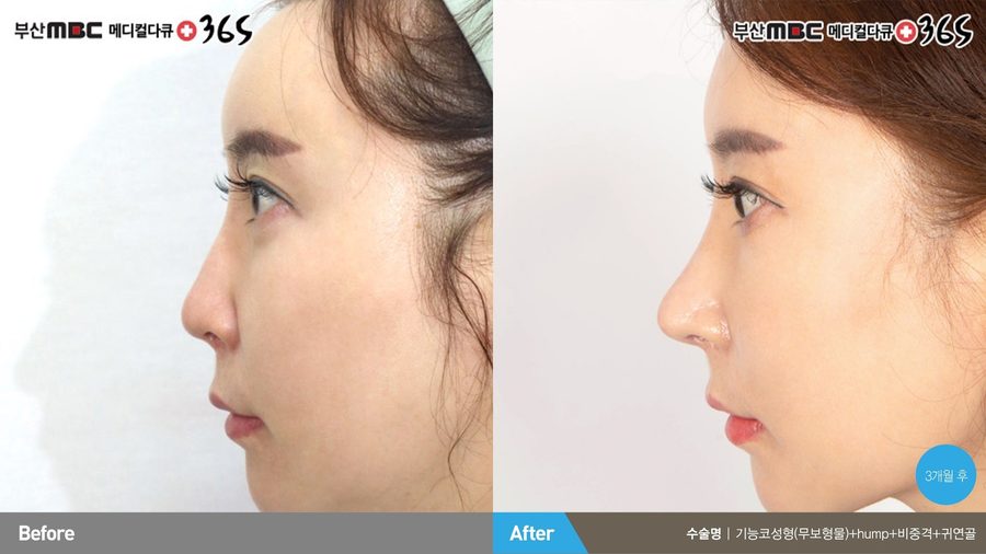Internal nasal valve reconstruction result — Newline Clinic Busan