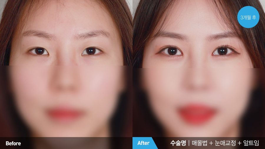 Subtle natural crease after non-incisional surgery — Newline Clinic Busan