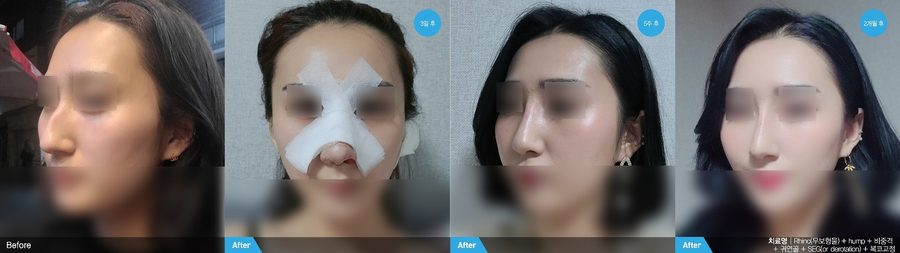 NewGel rhinoplasty front view result — Newline Clinic Busan