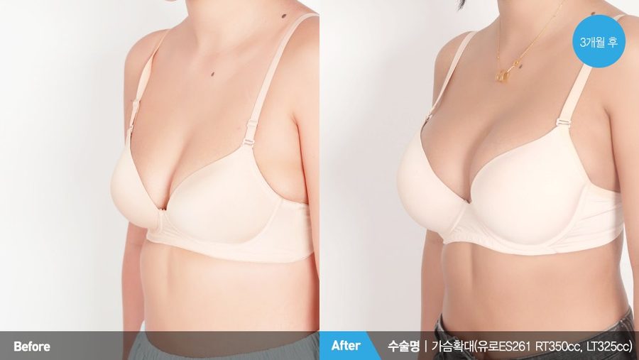 Bilateral inverted nipple correction result — Newline Clinic Busan