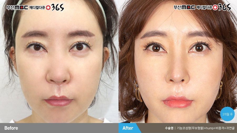 Facial harmony after rhinitis rhinoplasty — Newline Clinic