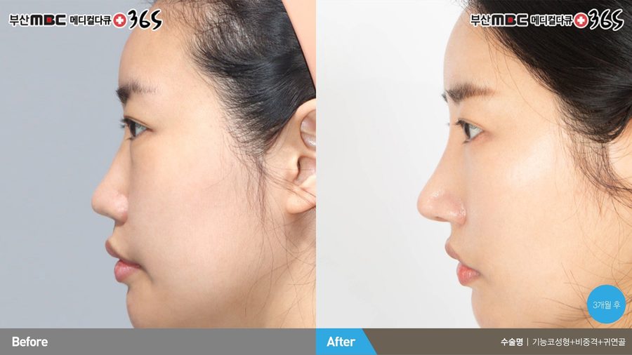 Combined rhinitis surgery and cosmetic rhinoplasty result — Newline Clinic