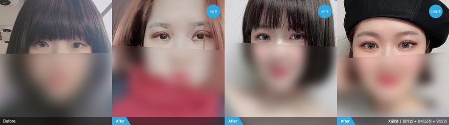 Softer tear trough after under-eye fat surgery — Newline Clinic Busan