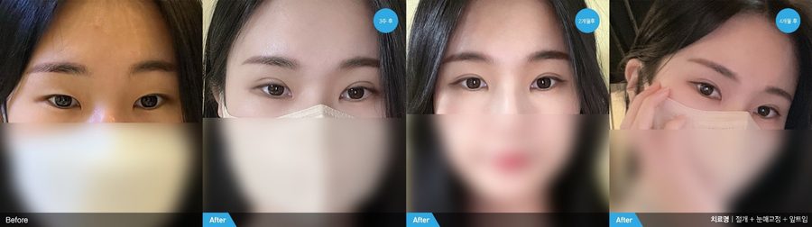 Excess upper eyelid skin corrected — Newline Clinic Busan